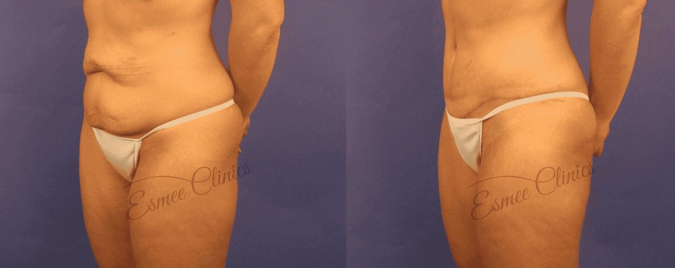 Before and After img